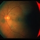 Subretinal & Epiretinal Pigment